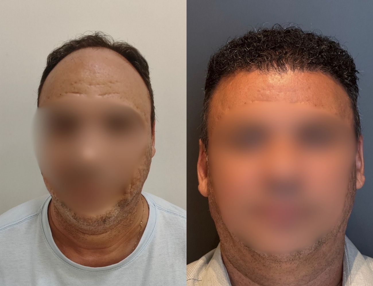 Antes e depois - Reconstrução da linha frontal